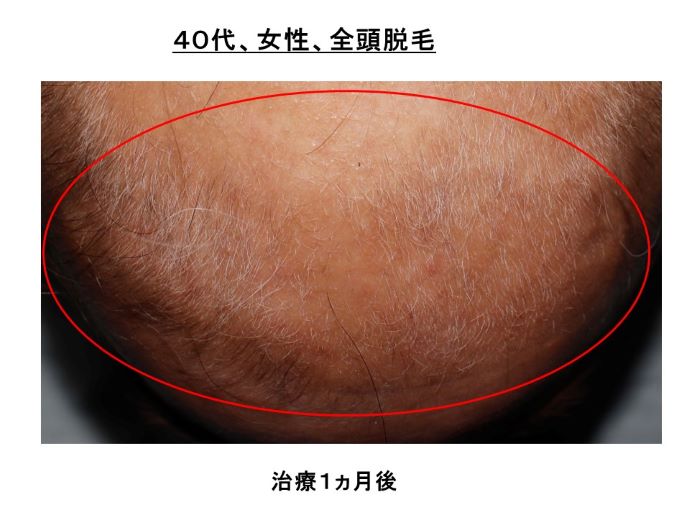円形脱毛症　病院